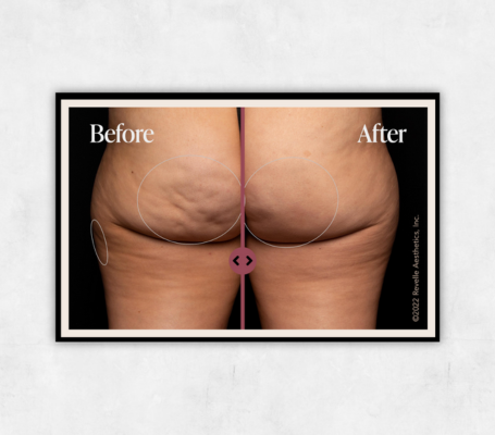 Case study for Avéli